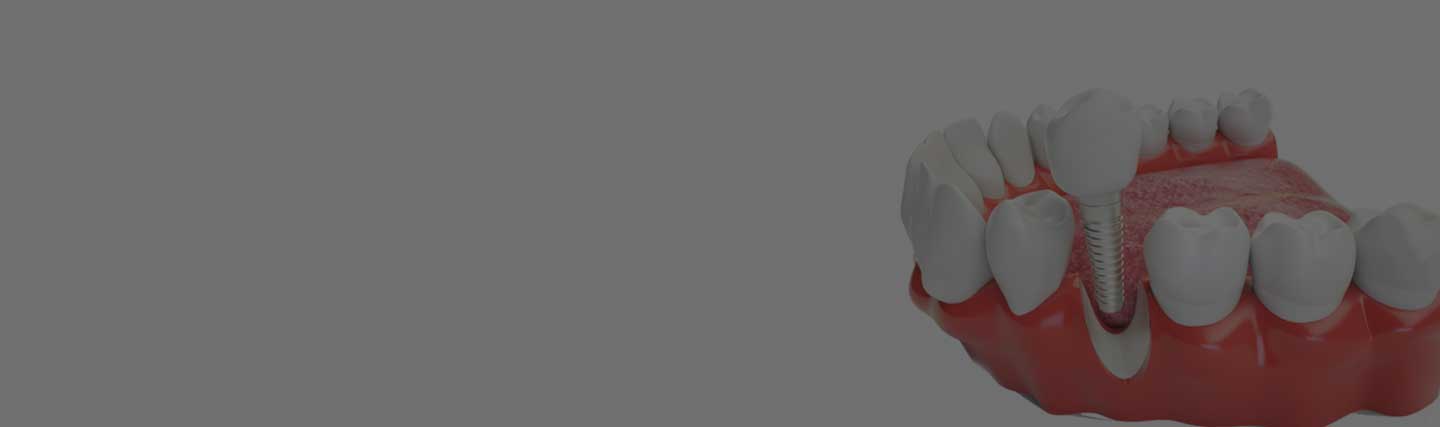 All-On-4 Dental İmplantlar
