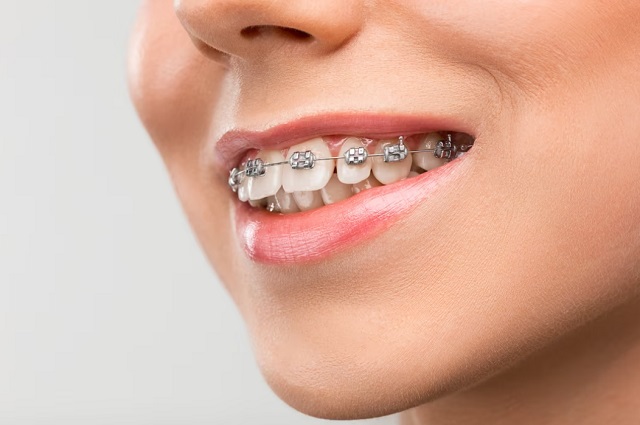 ortodontik-tedavi-nedir