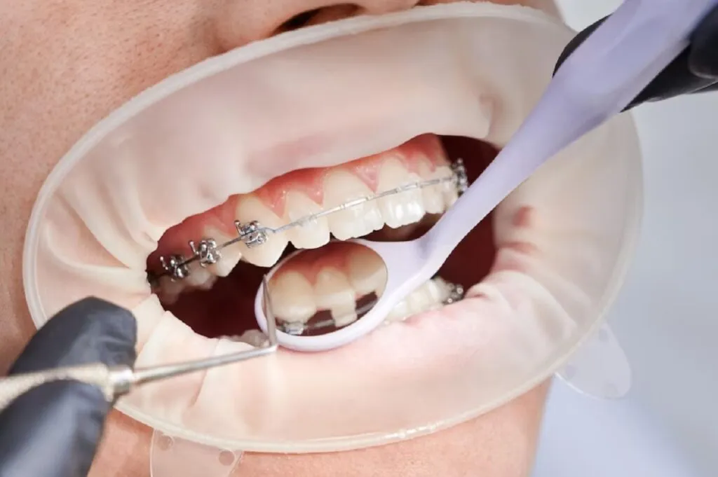 ortodontik-tedavi-nedir