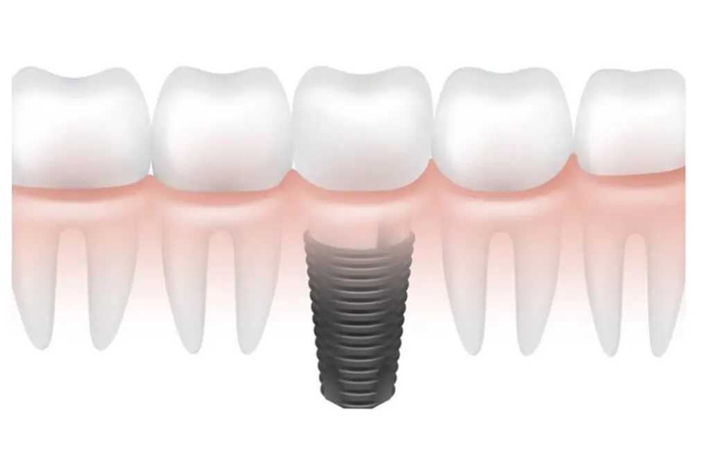 adim-adim-implant-asamalari-resimli