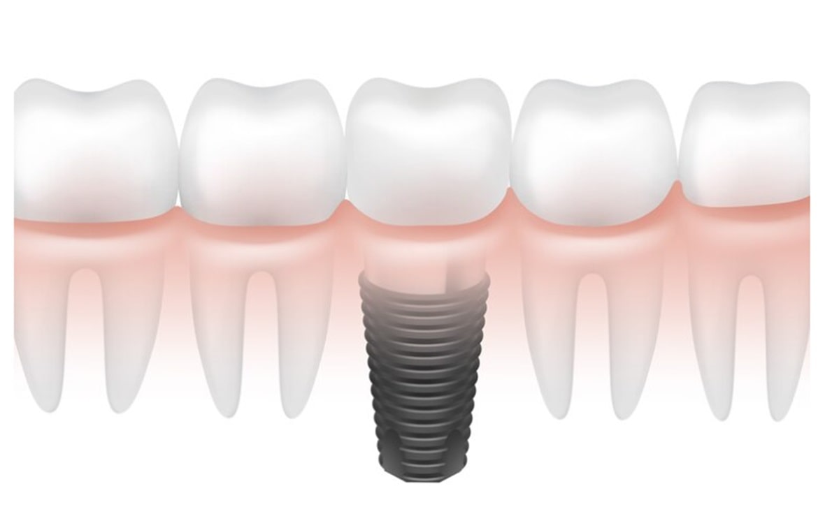 adim-adim-implant-asamalari-resimli