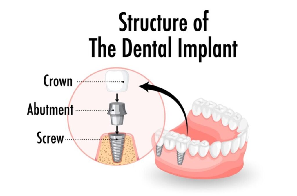 dentis-implant-markasi-nedir-