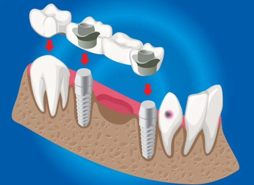 en-iyi-implant-markalari-