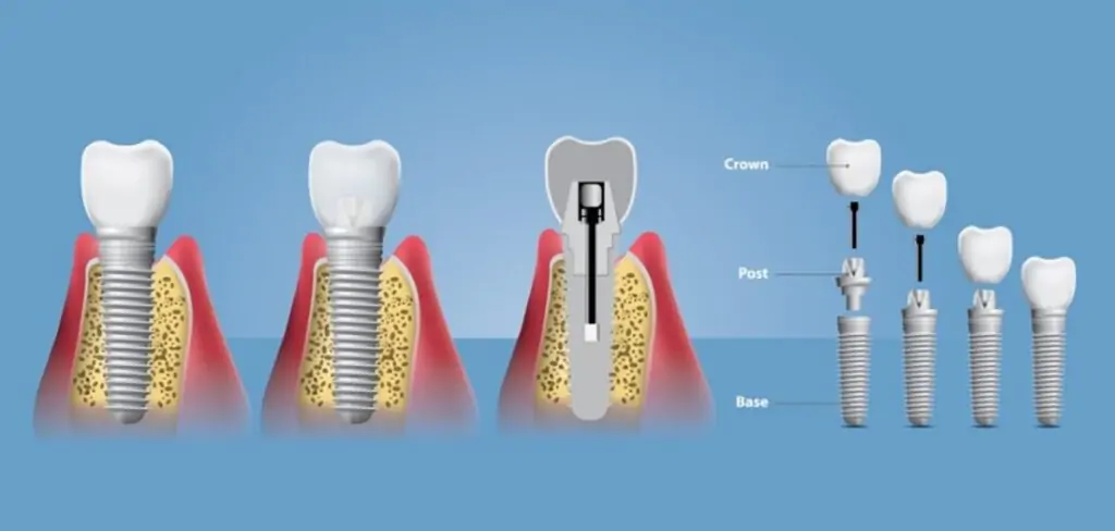 implant-sonrasi-nelere-dikkat-edilmeli-