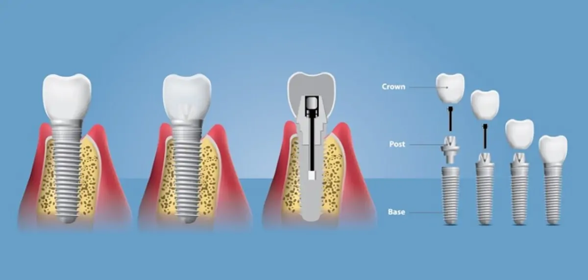 implant-sonrasi-nelere-dikkat-edilmeli-