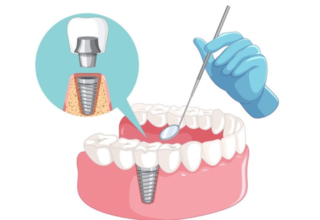 implant-vidasi-takildiktan-sonra-dis-ne-zaman-takilir-