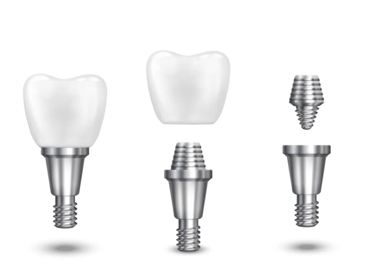 kirilmis-alana-dis-implant-nasil-yapilir