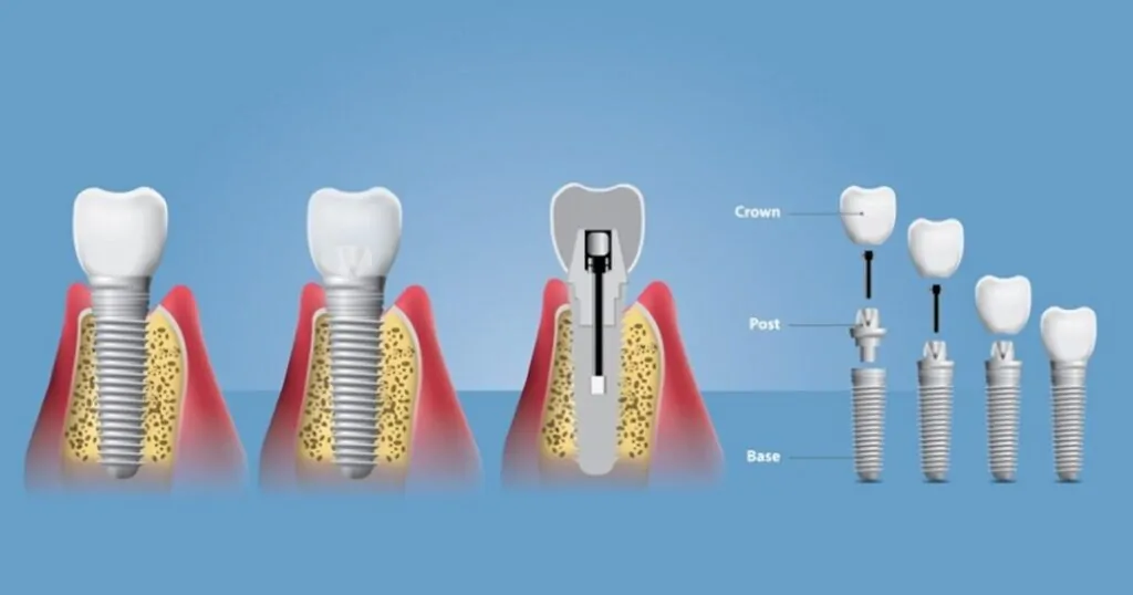 implant-vidasi-gorunur-mu-