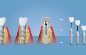 implant-vidasi-gorunur-mu-