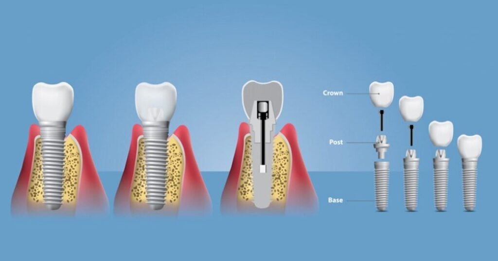 implant-sonrasi-sikintilar-yasamamak-icin