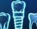 1-implant-kac-dis-tutar