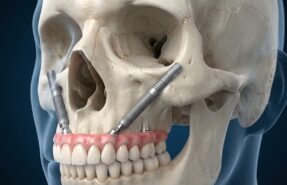 zigoma-implant-ust-sabit-protez
